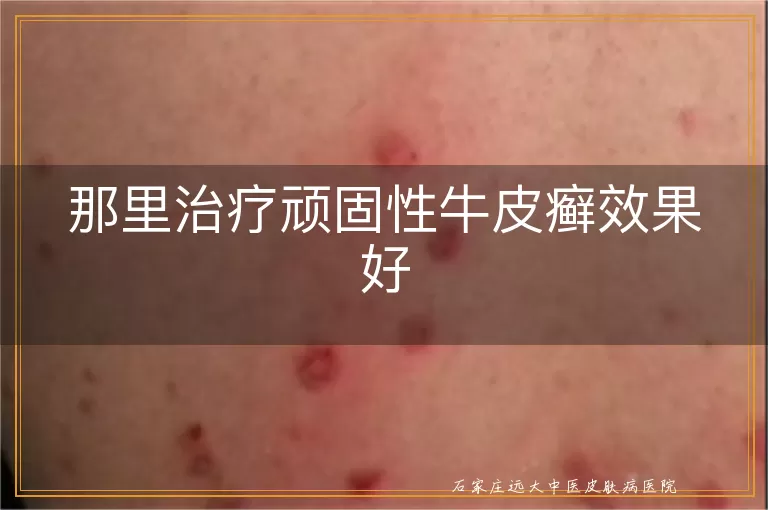 那里治疗顽固性牛皮癣效果好