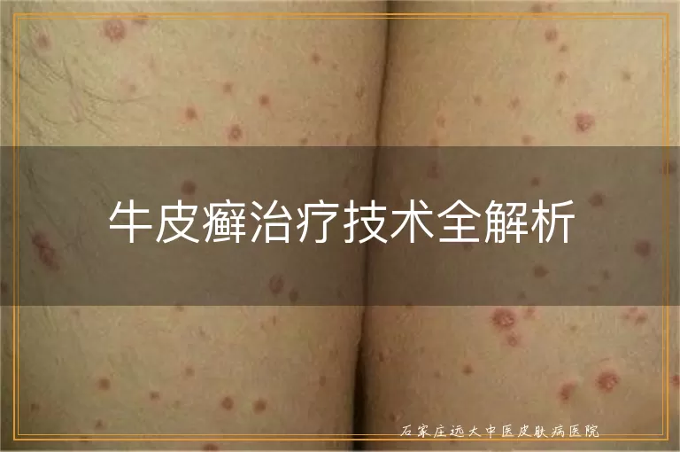 牛皮癣治疗技术全解析