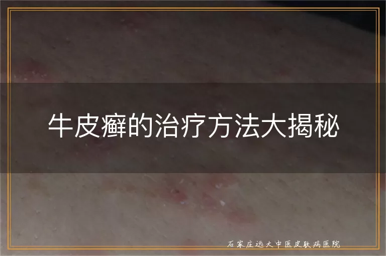 牛皮癣的治疗方法大揭秘