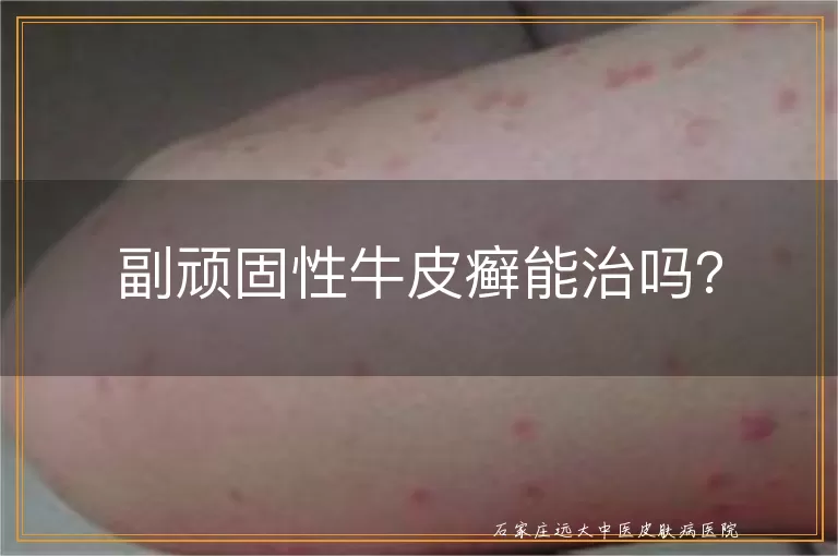 副顽固性牛皮癣能治吗？