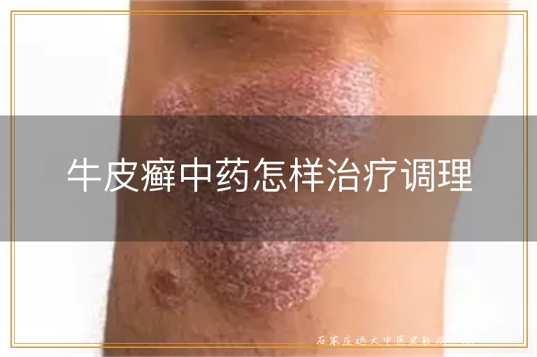 牛皮癣中药怎样治疗调理