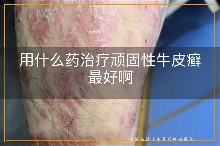 用什么药治疗顽固性牛皮癣最好啊