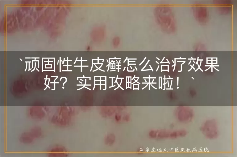 顽固性牛皮癣怎么治疗效果好？实用攻略来啦！
