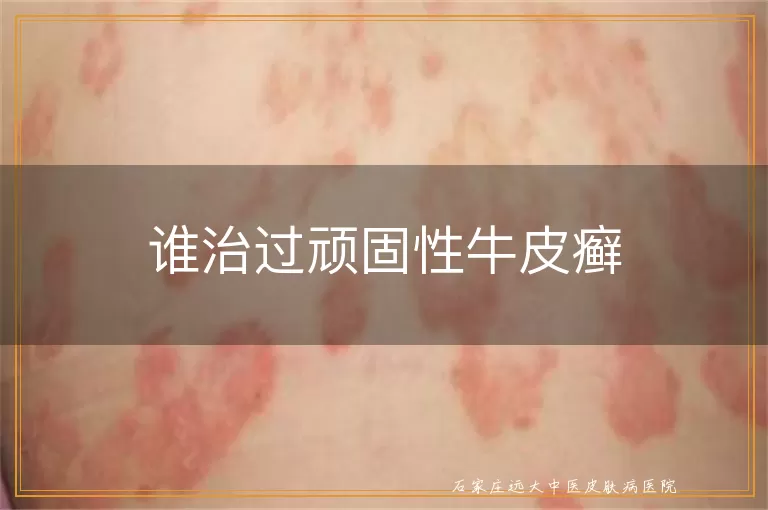 谁治过顽固性牛皮癣