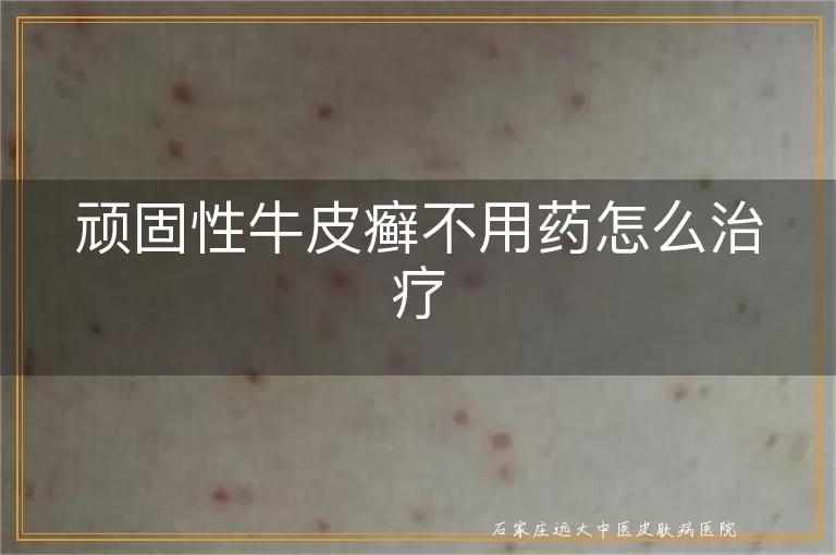 顽固性牛皮癣不用药怎么治疗