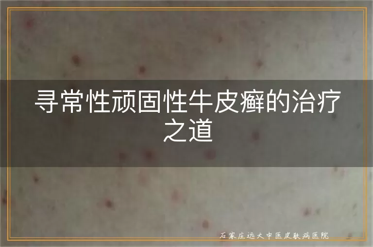 寻常性顽固性牛皮癣的治疗之道