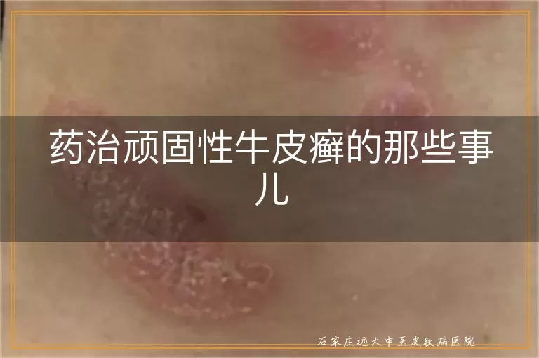 药治顽固性牛皮癣的那些事儿