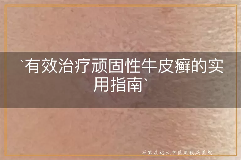 有效治疗顽固性牛皮癣的实用指南