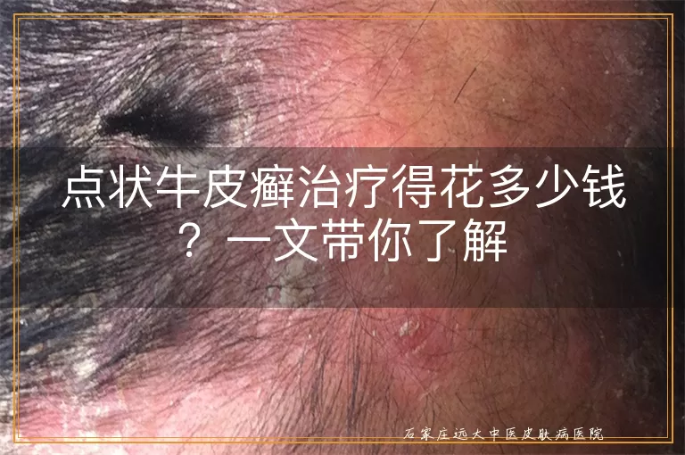 点状牛皮癣治疗得花多少钱?一文带你了解