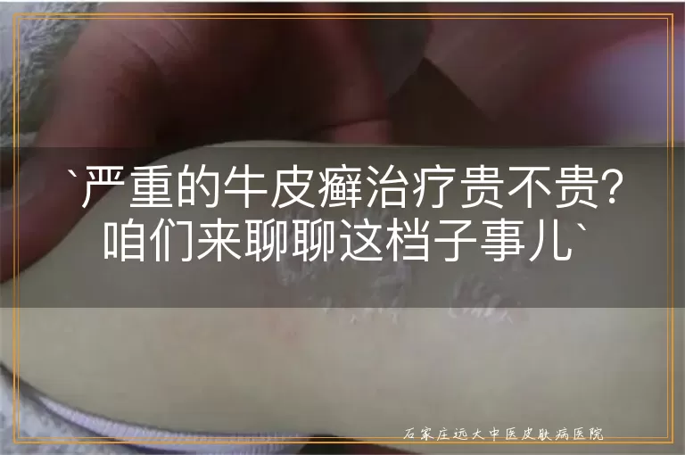 严重的牛皮癣治疗贵不贵？咱们来聊聊这档子事儿
