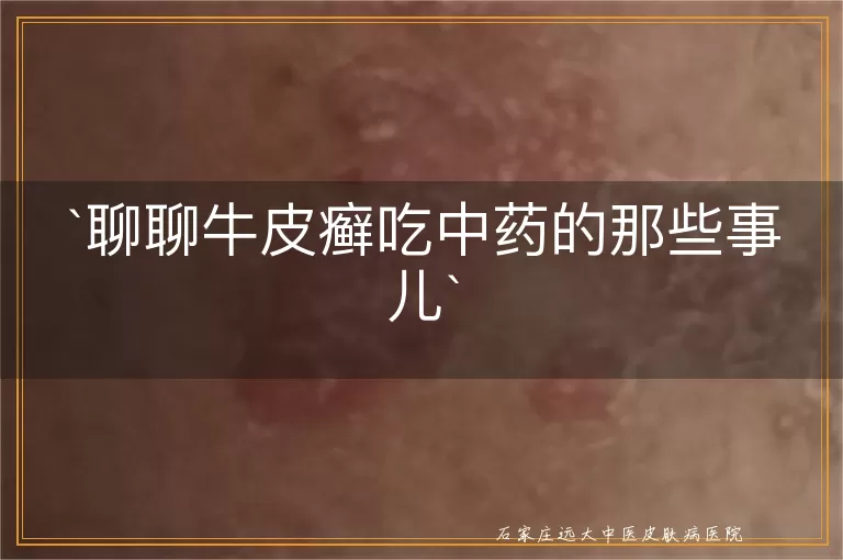 聊聊牛皮癣吃中药的那些事儿