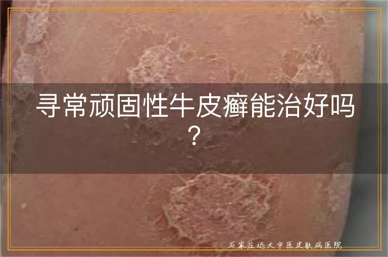 寻常顽固性牛皮癣能治好吗？