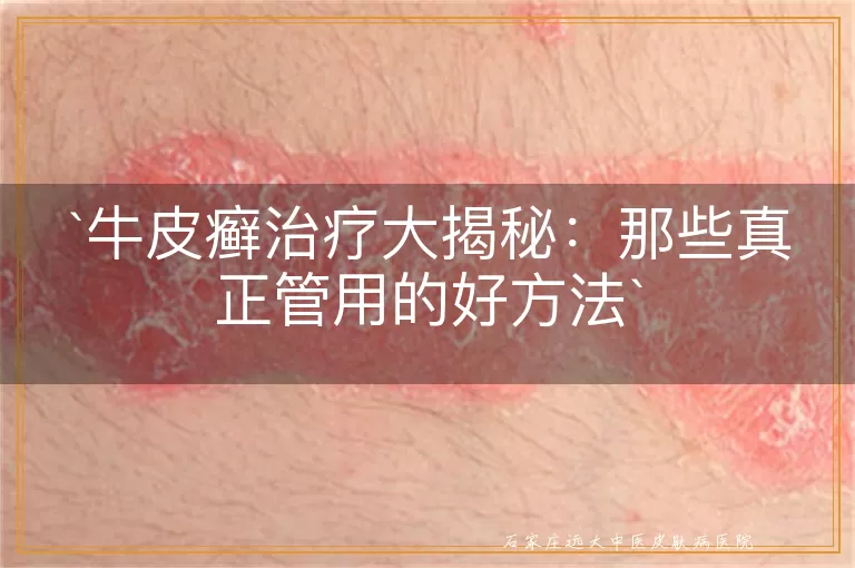 牛皮癣治疗大揭秘：那些真正管用的好方法