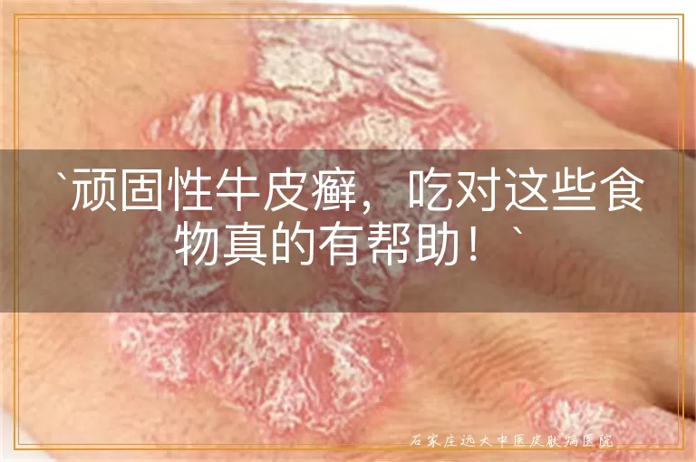 顽固性牛皮癣,吃对这些食物真的有帮助!
