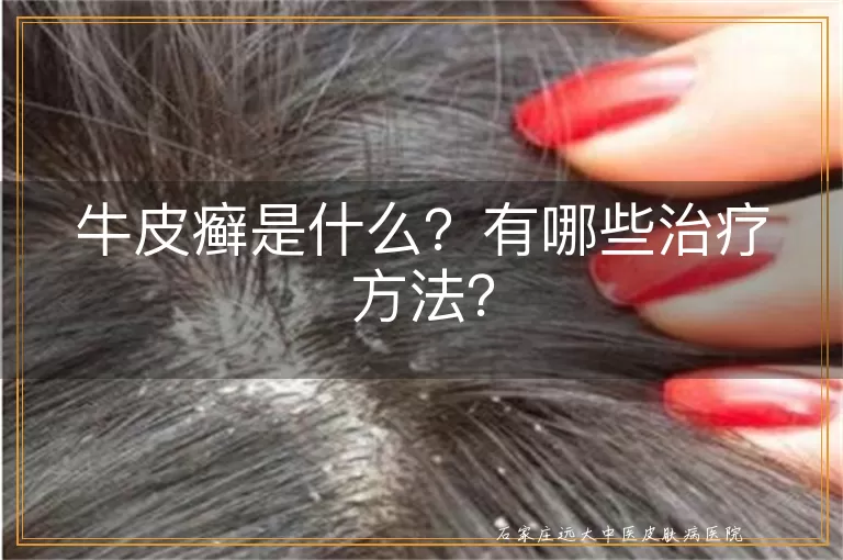 牛皮癣是什么?有哪些治疗方法?