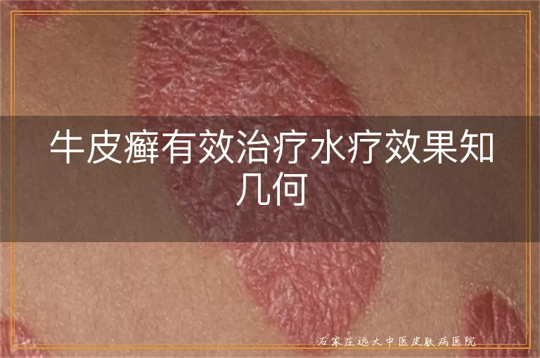 牛皮癣有效治疗水疗效果知几何