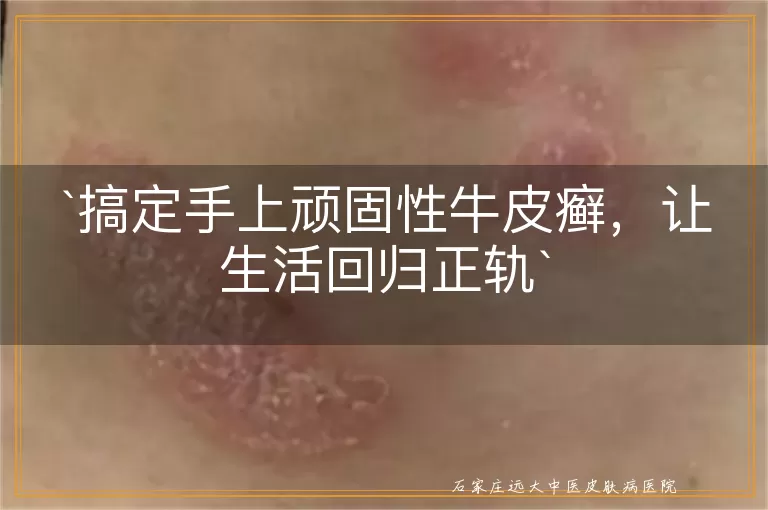 搞定手上顽固性牛皮癣，让生活回归正轨