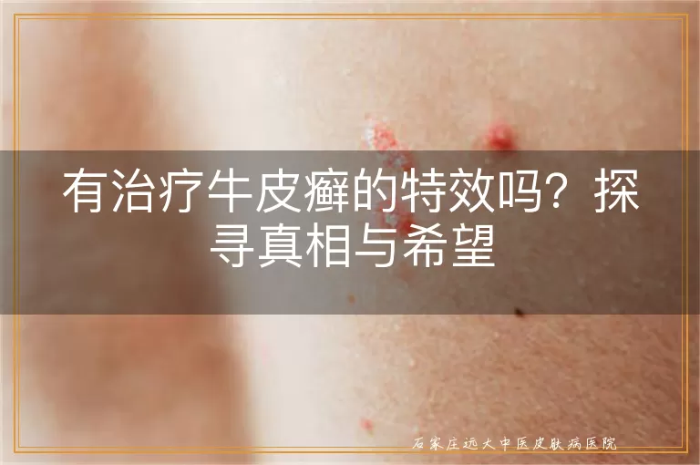 有治疗牛皮癣的特效吗?探寻真相与希望