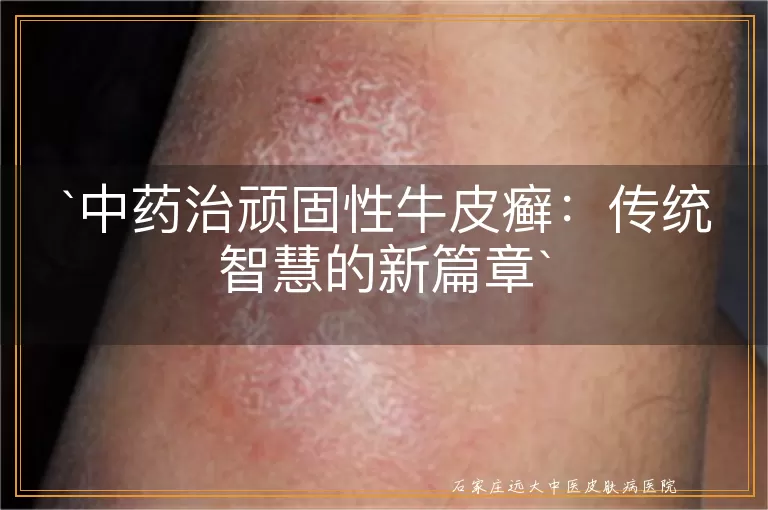 中药治顽固性牛皮癣：传统智慧的新篇章