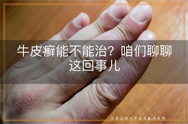 牛皮癣能不能治?咱们聊聊这回事儿