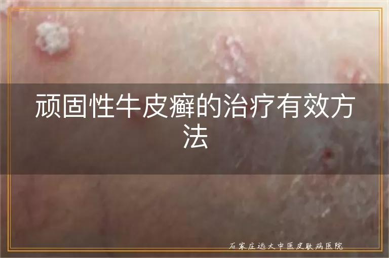 顽固性牛皮癣的治疗有效方法