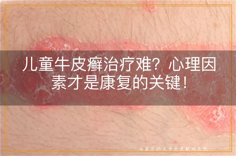 儿童牛皮癣治疗难?心理因素才是康复的关键!