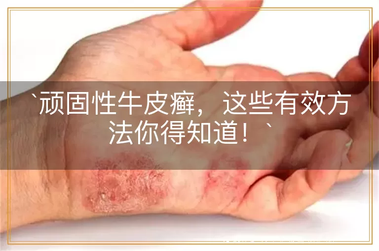 顽固性牛皮癣,这些有效方法你得知道!