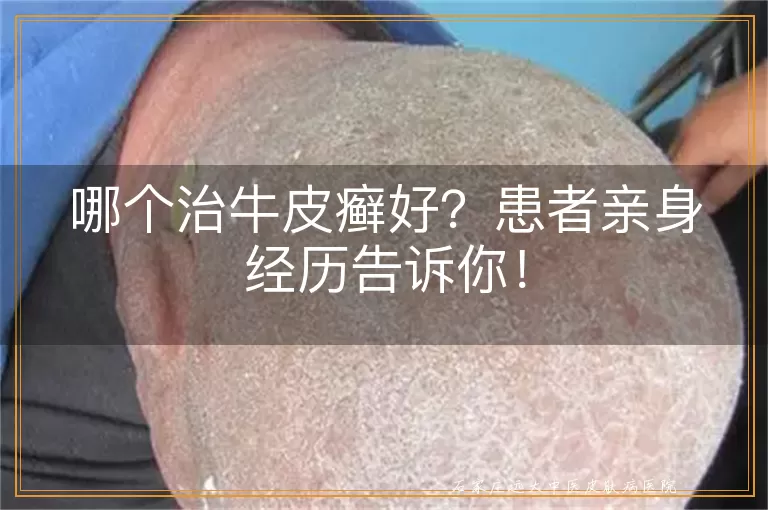 哪个治牛皮癣好?患者亲身经历告诉你!