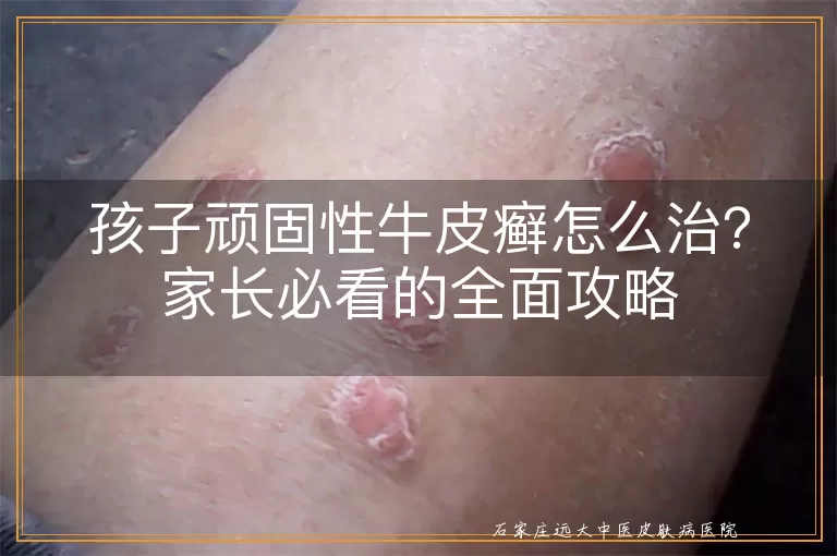 孩子顽固性牛皮癣怎么治？家长必看的全面攻略