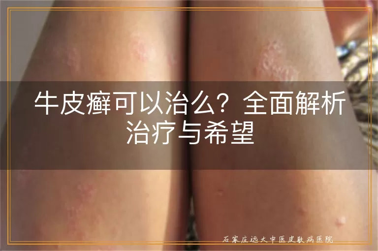 牛皮癣可以治么?全面解析治疗与希望