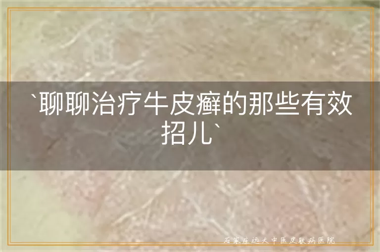 聊聊治疗牛皮癣的那些有效招儿