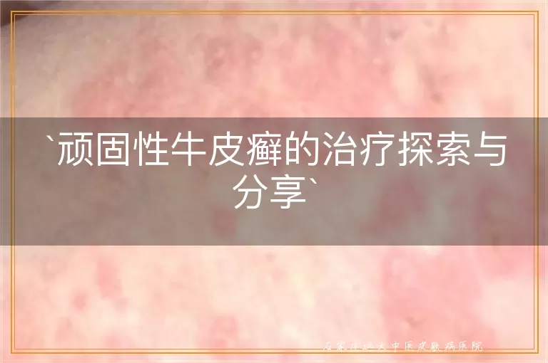 顽固性牛皮癣的治疗探索与分享