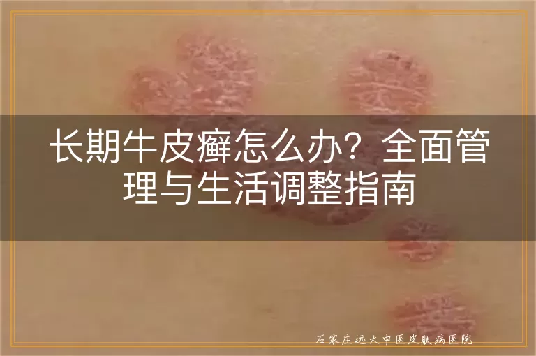 长期牛皮癣怎么办?全面管理与生活调整指南