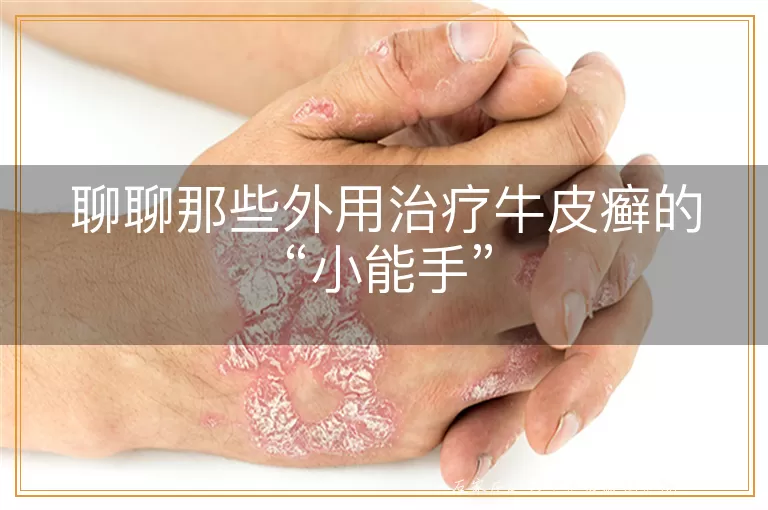 聊聊那些外用治疗牛皮癣的“小能手”