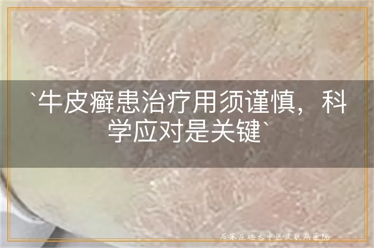 牛皮癣患治疗用须谨慎，科学应对是关键