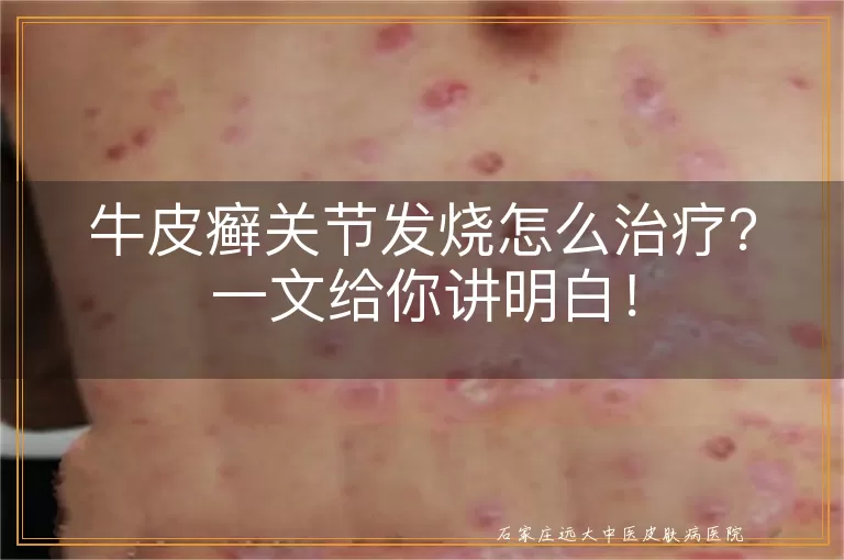 牛皮癣关节发烧怎么治疗?一文给你讲明白!