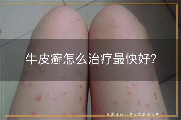 牛皮癣怎么治疗最快好？