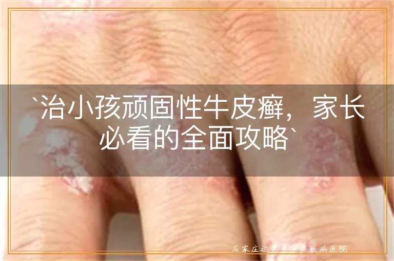治小孩顽固性牛皮癣，家长必看的全面攻略