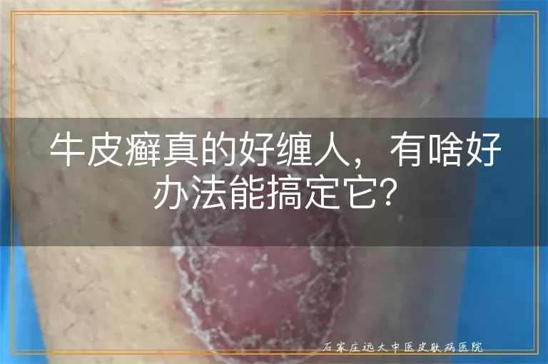 牛皮癣真的好缠人，有啥好办法能搞定它？