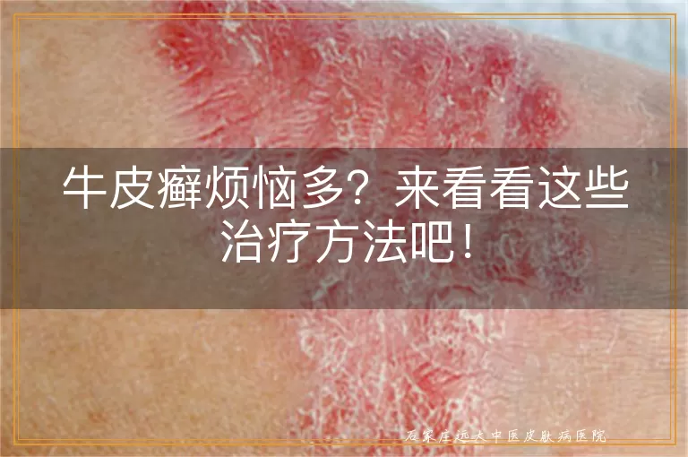 牛皮癣烦恼多？来看看这些治疗方法吧！