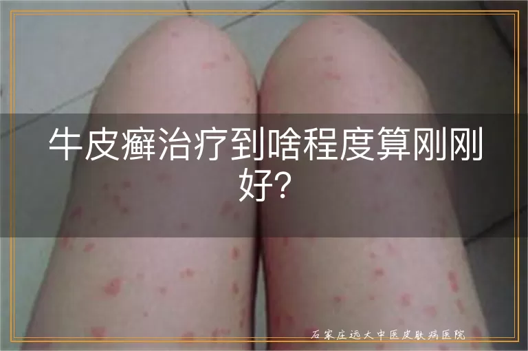 牛皮癣治疗到啥程度算刚刚好？