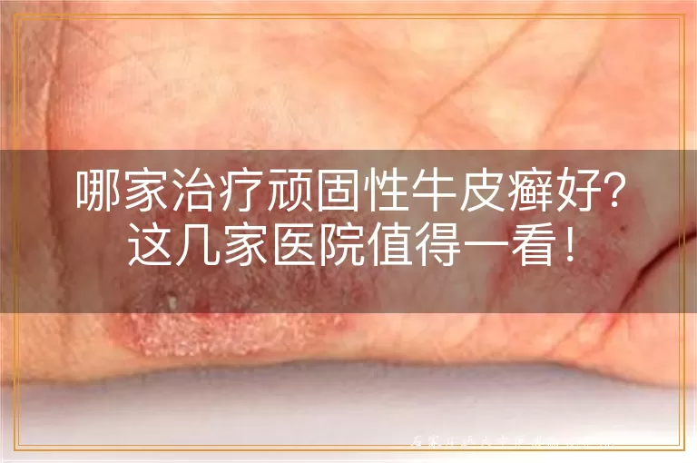 哪家治疗顽固性牛皮癣好？这几家医院值得一看！