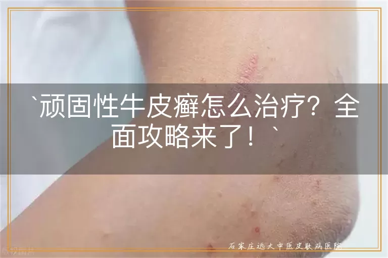 顽固性牛皮癣怎么治疗?全面攻略来了!