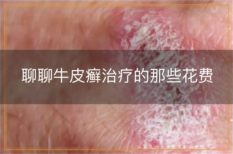 聊聊牛皮癣治疗的那些花费