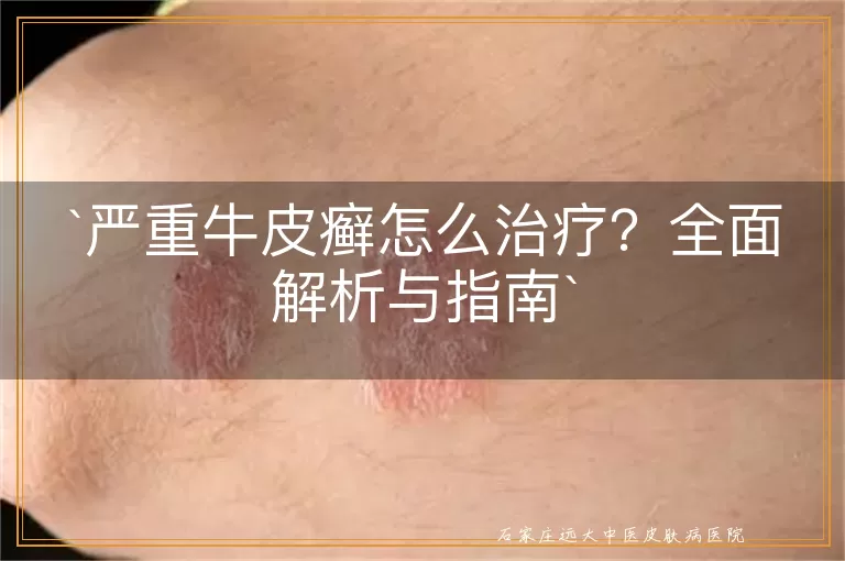 严重牛皮癣怎么治疗？全面解析与指南