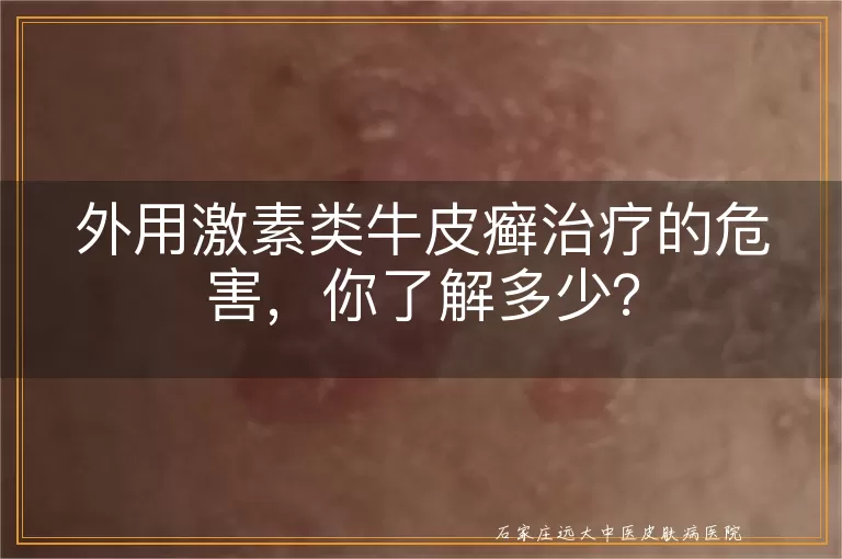 外用激素类牛皮癣治疗的危害，你了解多少？