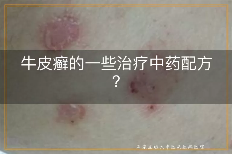 牛皮癣的一些治疗中药配方?