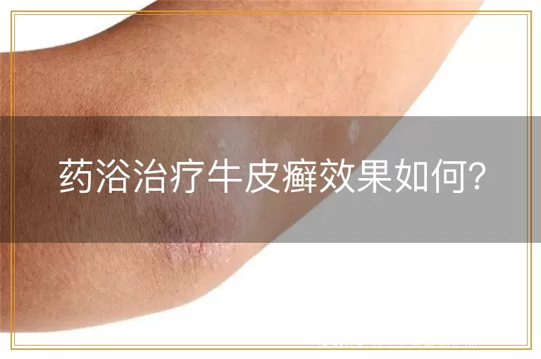 药浴治疗牛皮癣效果如何？