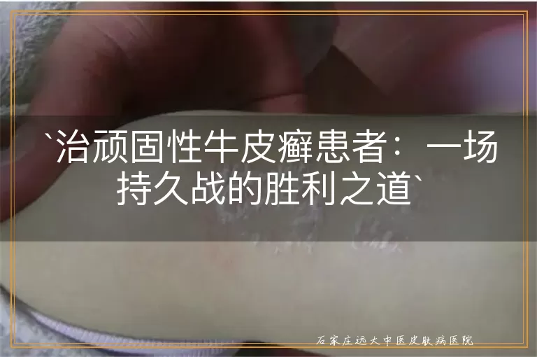 治顽固性牛皮癣患者：一场持久战的胜利之道