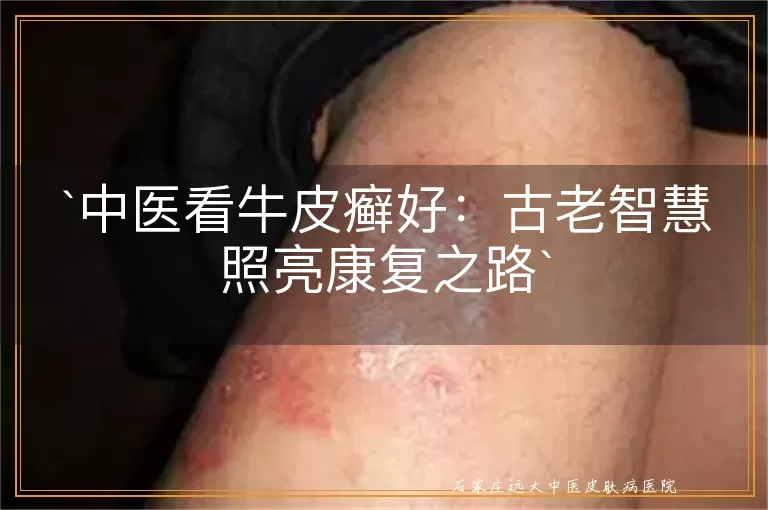 中医看牛皮癣好：古老智慧照亮康复之路